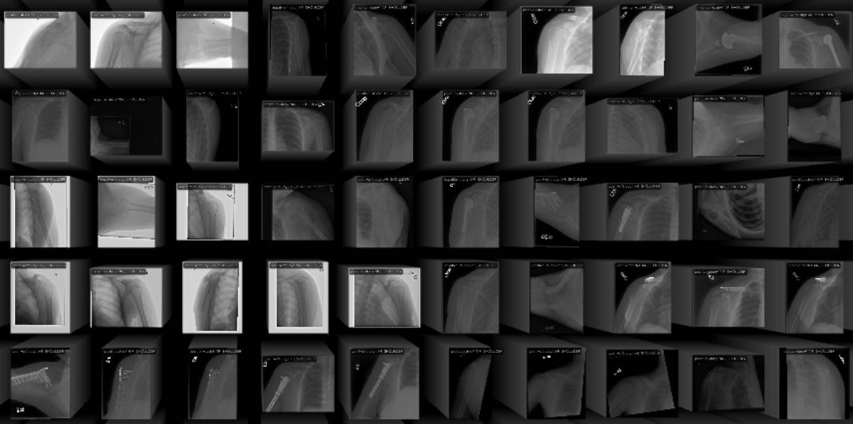 MURA Dataset - Machine Learning Datasets